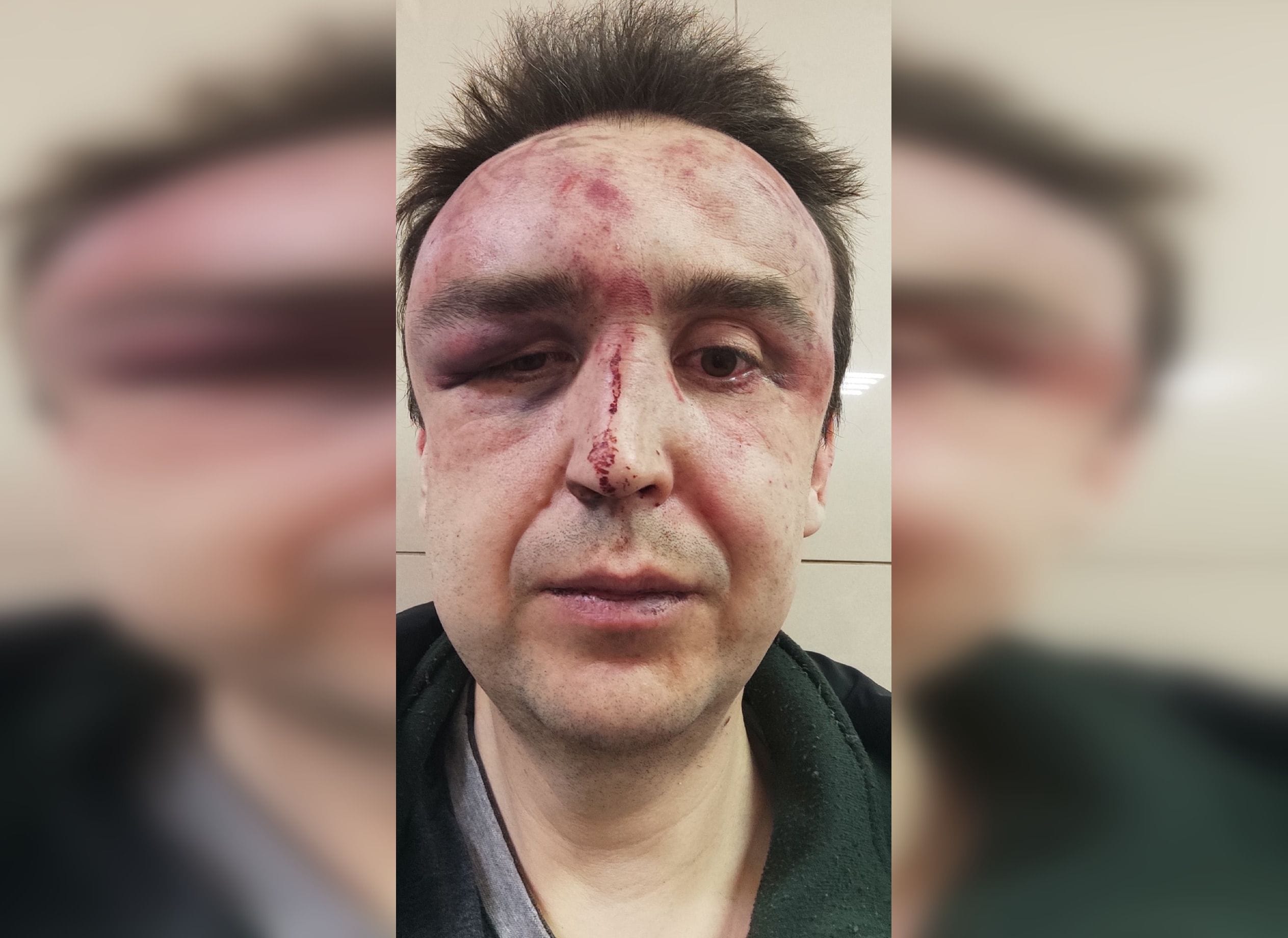 Военные избили жителя Рязани, приняв его за украинского диверсанта. Затем попытались выдать ситуацию за падение с мотоцикла 